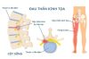 Trị Liệu Đau Thần Kinh Tọa – Chuyên Gia Thầy Hồ Bấm Huyệt