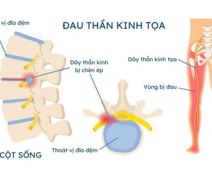 Đau Thần Kinh Tọa