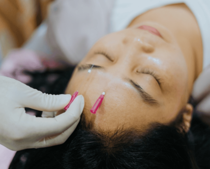 Phục Hồi Chức Năng Sau Tai Biến - Liệt Mặt