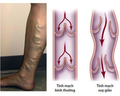 Suy giãn tĩnh mạch